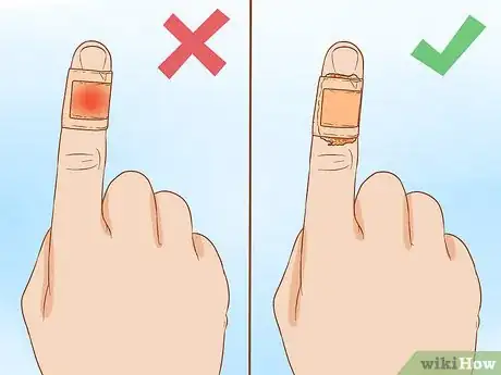 Imagen titulada Apply Different Types of Bandages Step 12