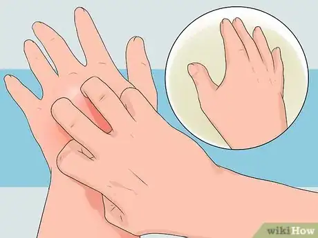 Imagen titulada Cure Insect Stings Step 5