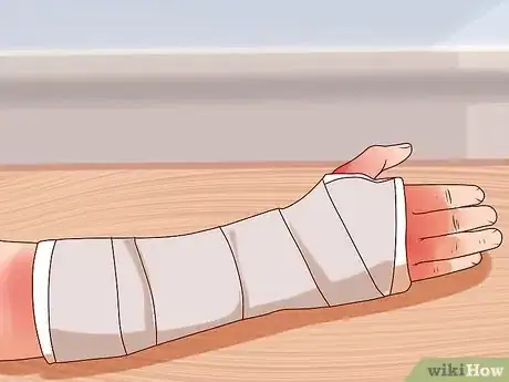 Imagen titulada Apply a Cast to a Broken Arm Step 11