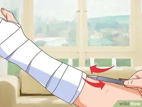 Imagen titulada Apply a Cast to a Broken Arm Step 13