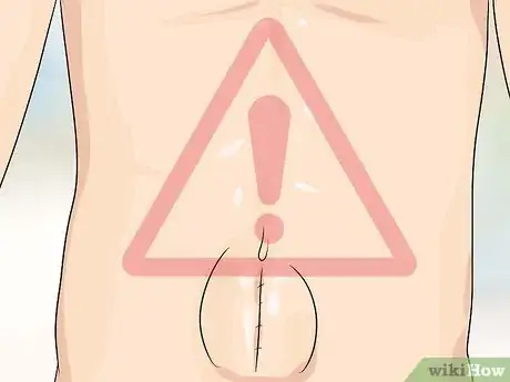 Imagen titulada Know if You Have a Hernia Step 19