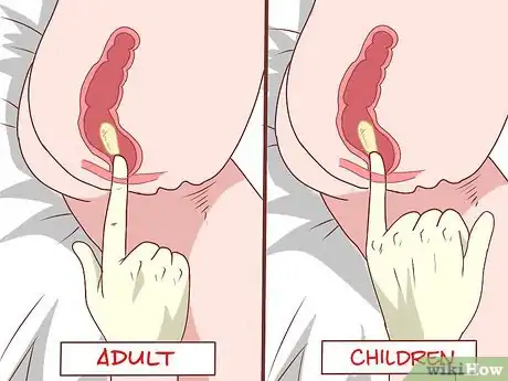 Imagen titulada Insert a Rectal Suppository Step 14