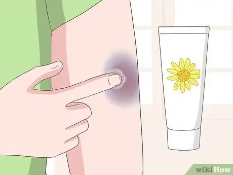 Imagen titulada Make a Bruise Go Away Faster Step 19