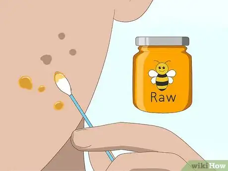 Imagen titulada Get Rid of Acne Scars Fast Step 13