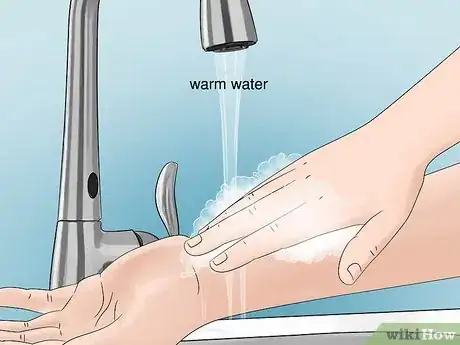 Imagen titulada Treat Flea Bites Step 1
