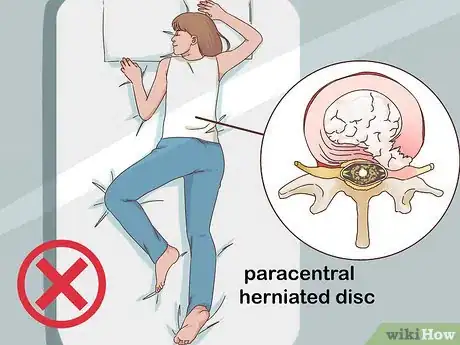 Imagen titulada Sleep with a Ruptured Disc Step 2