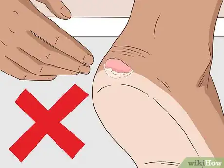 Imagen titulada Treat a Foot Blister Step 5