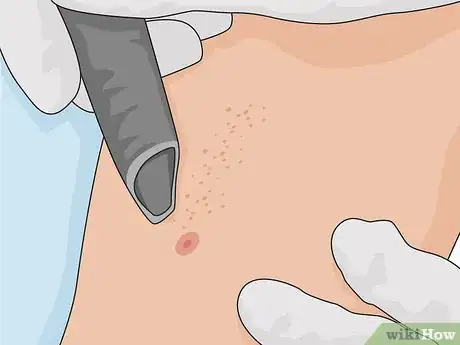 Imagen titulada Remove Scars on Legs Step 18