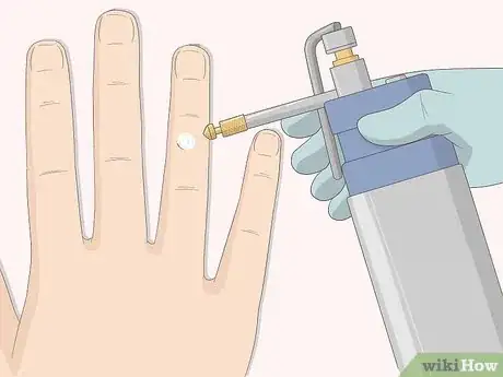 Imagen titulada Get Rid of Warts Step 5