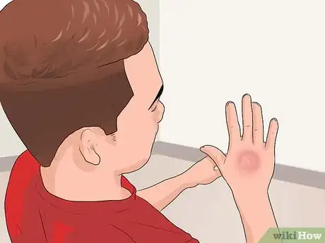 Imagen titulada Cure Insect Stings Step 6