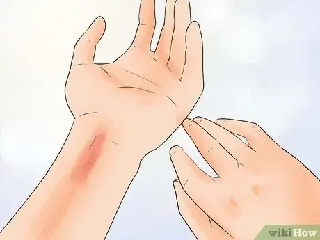 Imagen titulada Treat a Small Burn Step 9