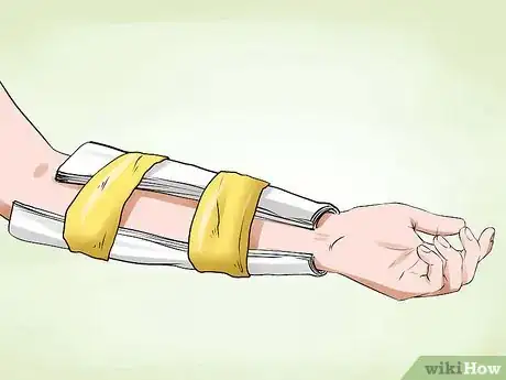 Imagen titulada Manage a Broken Arm Step 4
