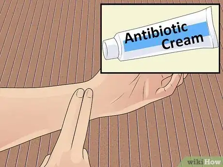 Imagen titulada Treat a Cat Bite Step 4