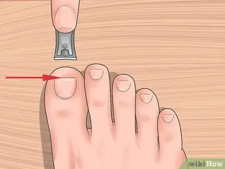 Imagen titulada Tell if You Have an Ingrown Toenail Step 10