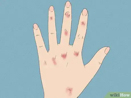 Imagen titulada Tell if Someone Is Bulimic Step 2