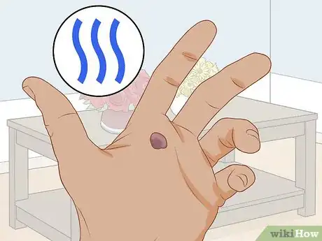 Imagen titulada Treat a Blood Blister Step 4
