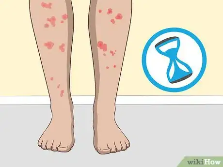 Imagen titulada Cure Lichen Planus Step 5