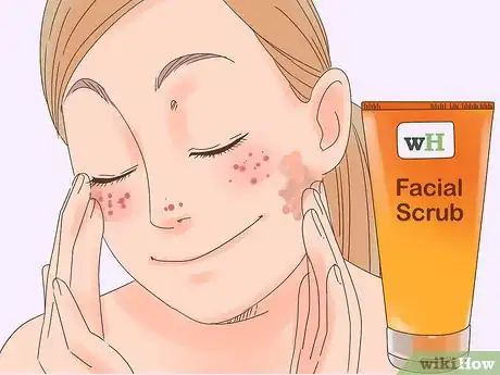 Imagen titulada Remove the Redness of a Pimple Step 19