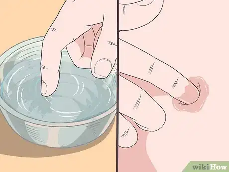 Imagen titulada Treat an Infection in Your Belly Button Step 9