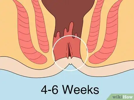 Imagen titulada Care for Anal Fissures Postpartum Step 8