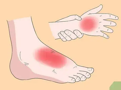 Imagen titulada Treat Extensor Tendonitis Step 6