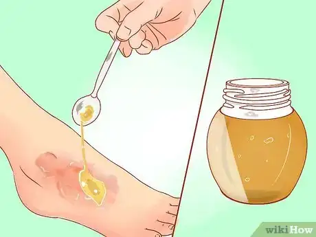 Imagen titulada Treat a Burn Using Honey Step 5