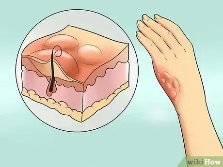 Imagen titulada Treat Minor Burns Step 2