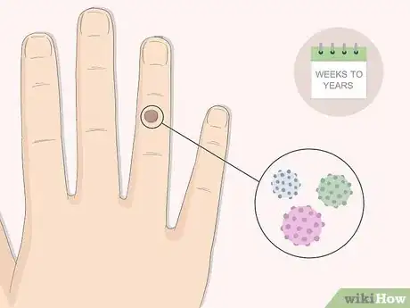 Imagen titulada Get Rid of Warts Step 1