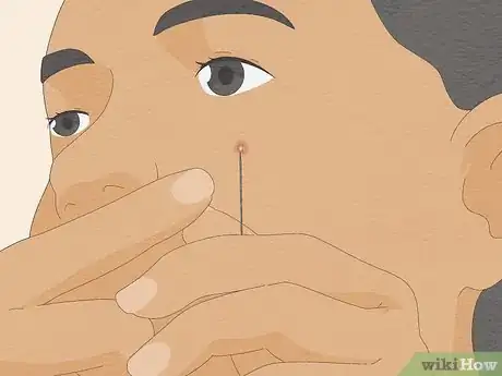 Imagen titulada Pop a Pimple Step 12
