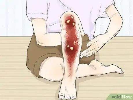 Imagen titulada Treat a Turf Burn Step 8