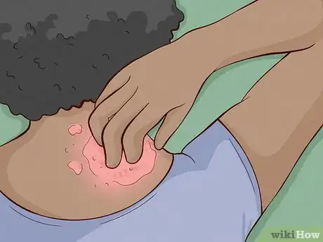 Imagen titulada Take Care of Dry Skin Step 15