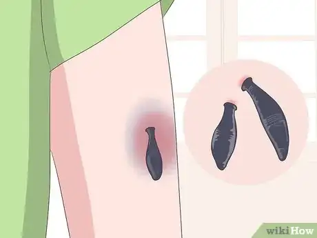 Imagen titulada Make a Bruise Go Away Faster Step 21