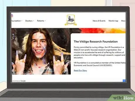 Imagen titulada Diagnose Vitiligo Step 14