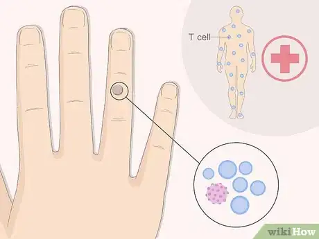 Imagen titulada Get Rid of Warts Step 8