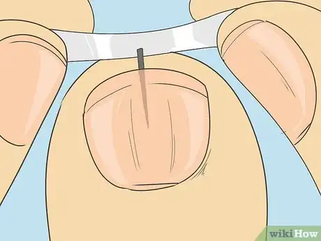 Imagen titulada Remove a Splinter Under Your Fingernail Step 7