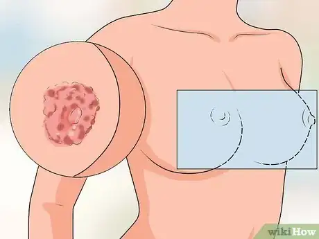 Imagen titulada Treat Itchy Breasts Step 20