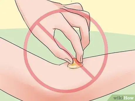 Imagen titulada Pop a Blister Step 1