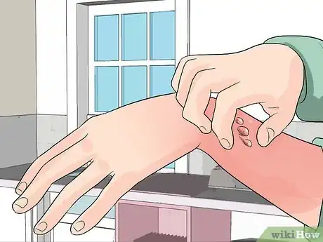 Imagen titulada Treat a Blistered Sunburn Step 25
