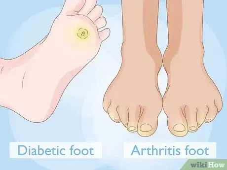 Imagen titulada Treat a Sore Toe Step 8
