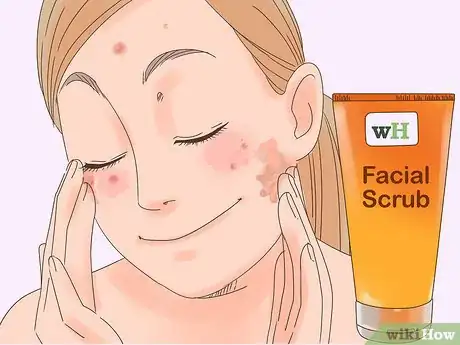 Imagen titulada Remove the Redness of a Pimple Step 19
