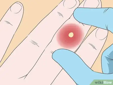 Imagen titulada Cure an Infected Finger Step 6