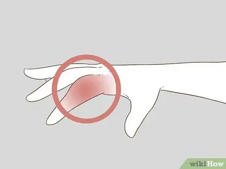 Imagen titulada Determine if a Finger Is Broken Step 2