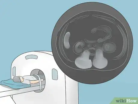 Imagen titulada Test for Kidney Disease Step 9