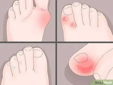 Imagen titulada Treat a Sore Toe Step 7
