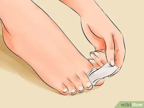 Imagen titulada Remove an Ingrown Toenail Step 17