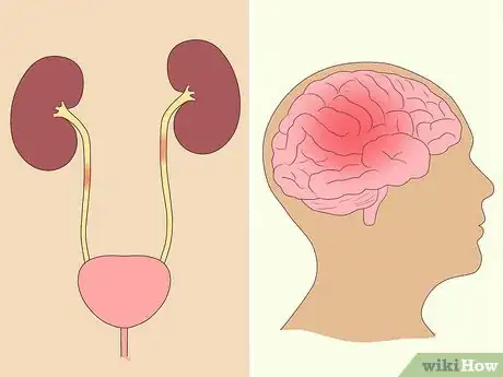 Imagen titulada Treat an Overactive Bladder Naturally Step 15