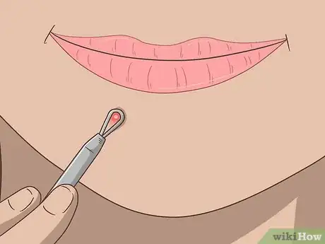 Imagen titulada Get Rid of a Pimple Step 2