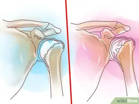 Imagen titulada Know if Left Arm Pain Is Heart Related Step 11