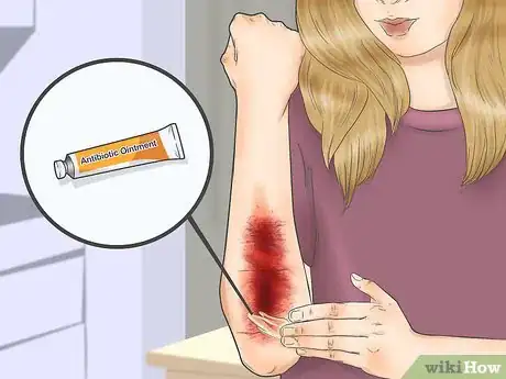 Imagen titulada Treat a Turf Burn Step 2