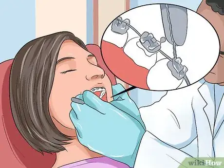 Imagen titulada Choose the Color of Your Braces Step 9